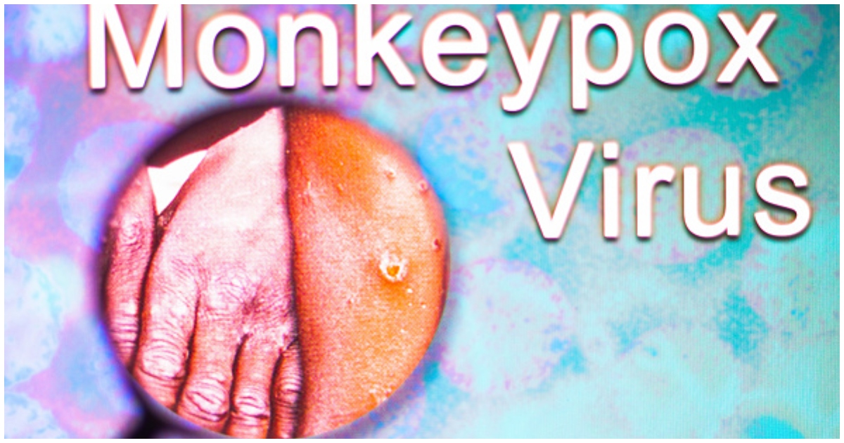 Monkeypox image