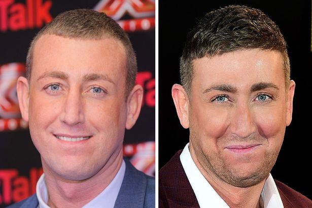 hooded eyes celebrity blepharoplasty before and after