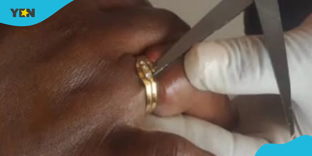 Faustina almost lost her ring finger after a ring she bought from a friend got stuck on her hand.