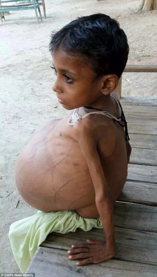 Boy, 9, has stomach size of a beach ball due to rare disease