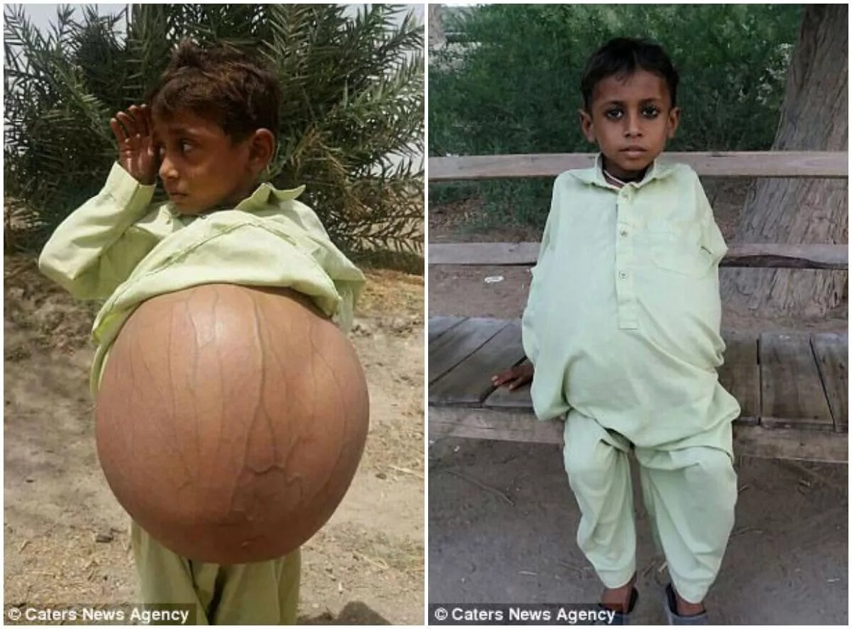 Boy, 9, has stomach size of a beach ball due to rare disease