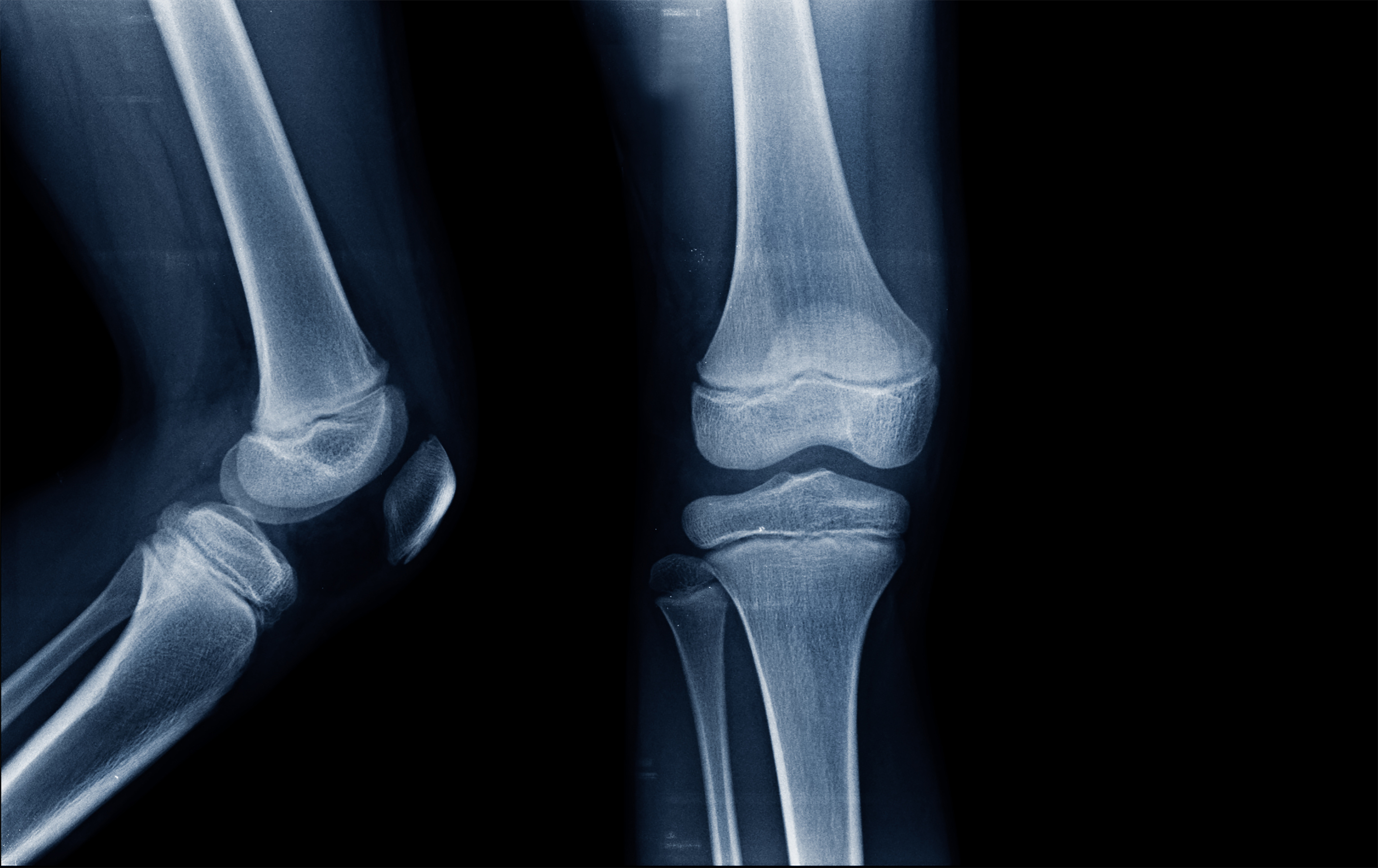 An x-ray of a child knee
