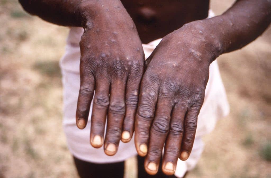 US health officials warn: Spread of monkeypox high among gay, bisexual