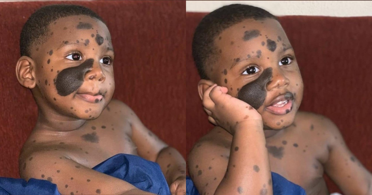 Adorable photos of a boy looking cute with his birthmarks go viral