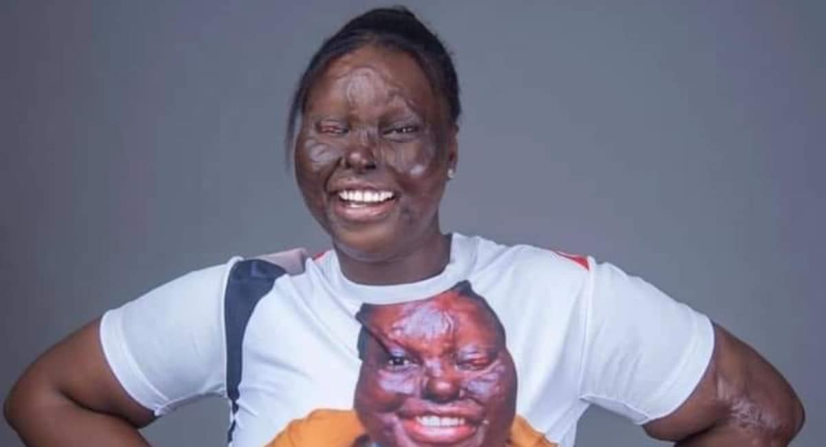 Nigerian acid survivor celebrates 16 years of being alive after unfortunate incident