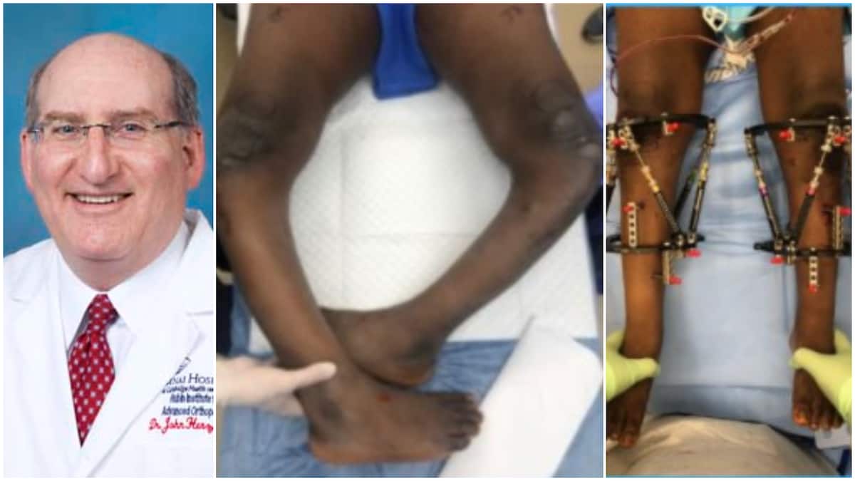 Photos show how white doctor corrected boy's bow legs to make them straight