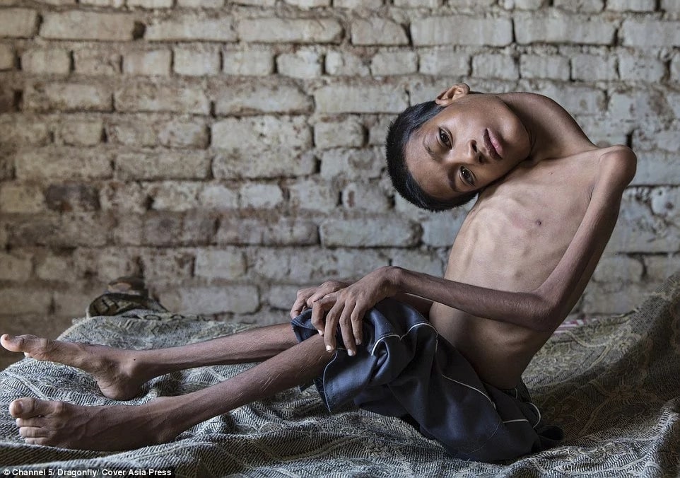 Photos: Boy with upside down head gets life-changing surgery