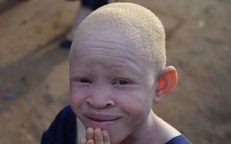 We shall sue GIS over discriminatory recruitment process - Association of Albinos fume