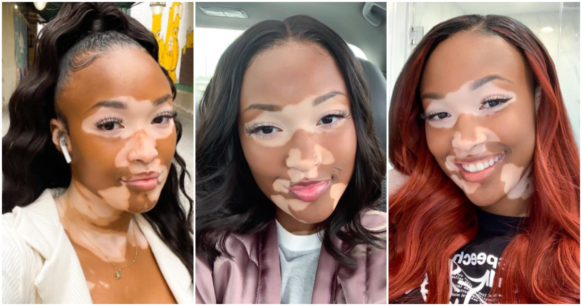 “You're so beautiful”: Pretty lady shows off her unique skin; many gush over her photo