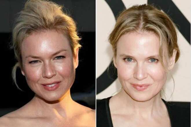 Celebrity blepharoplasty before and after