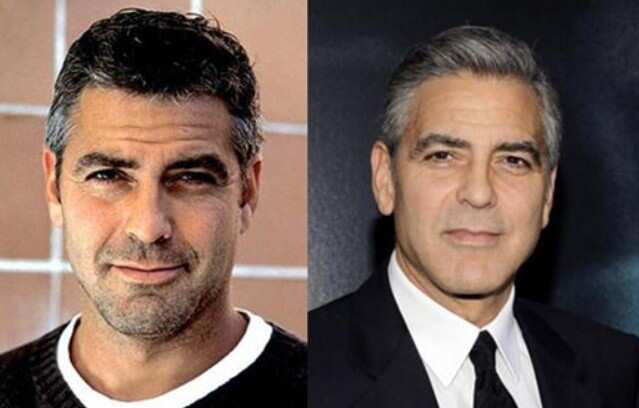 celebrity blepharoplasty before and after