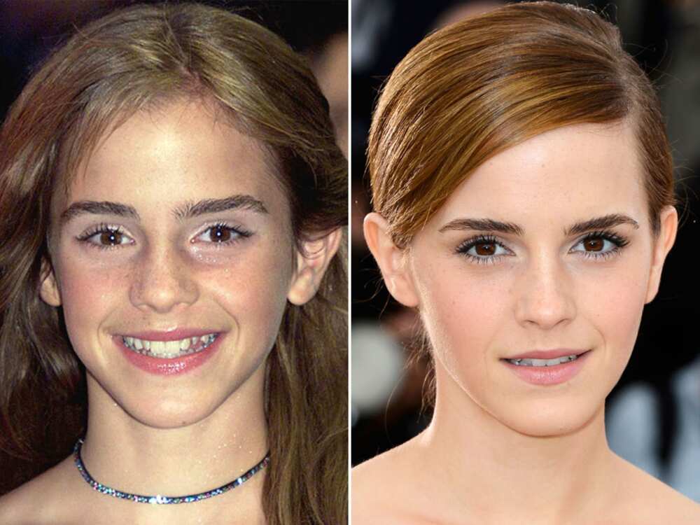 Emma Watson Before And After Braces