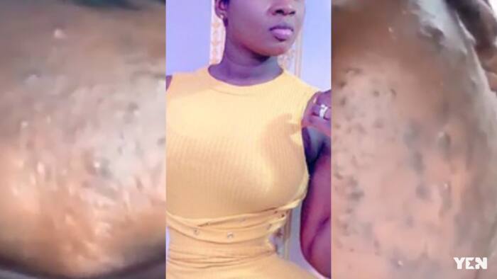 Princess Shyngle cries for good cream; shows her real face full of pimples (Video)