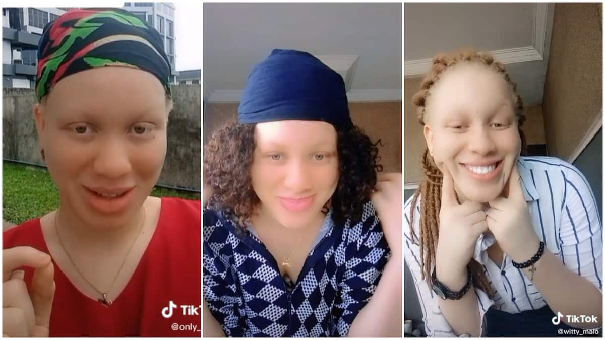 Living with albinism in Nigeria/albino without dark spots.