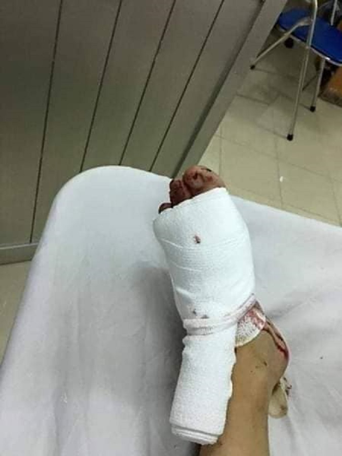 A photo of an injured foot