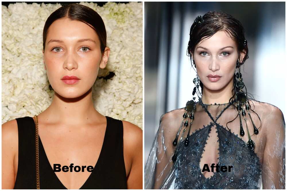 bella hadid's plastic surgeries before and after