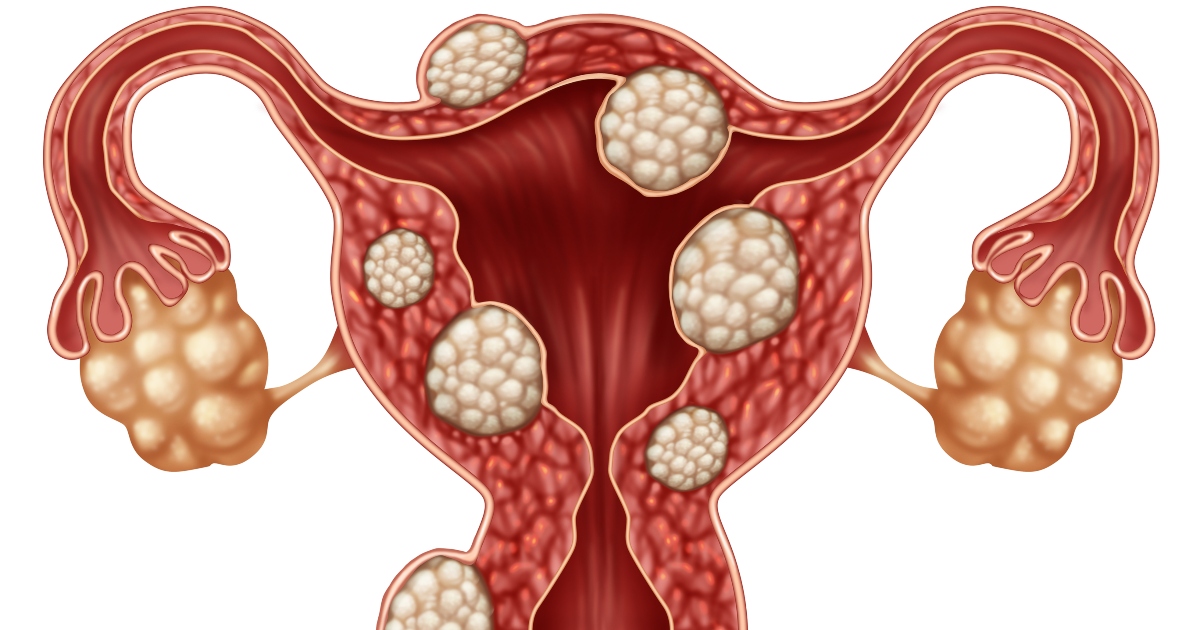The effect fibroids have on fertility