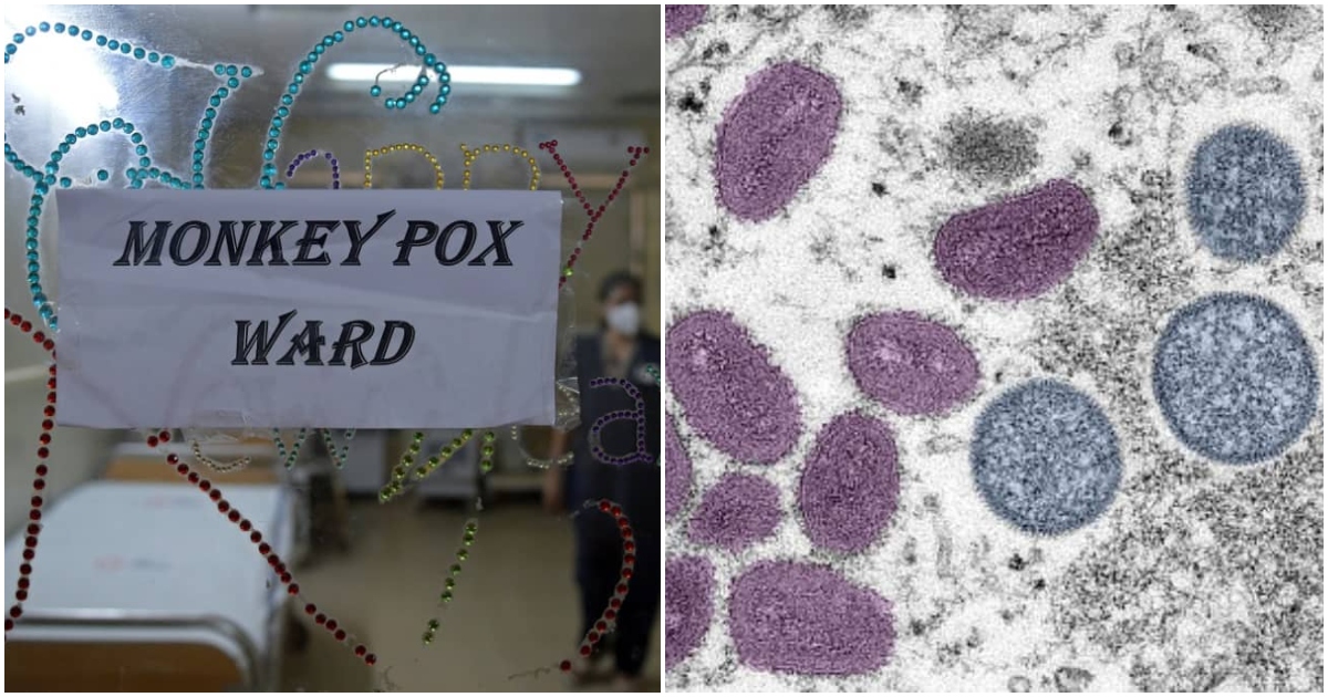 Monkeypox outbreak hits Greater Accra, 55 cases and one death recorded