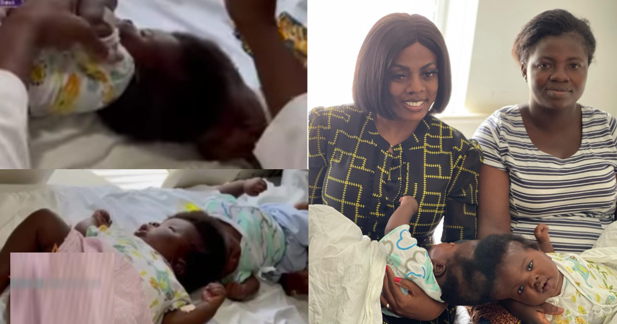 Conjoined twins with Nana Aba