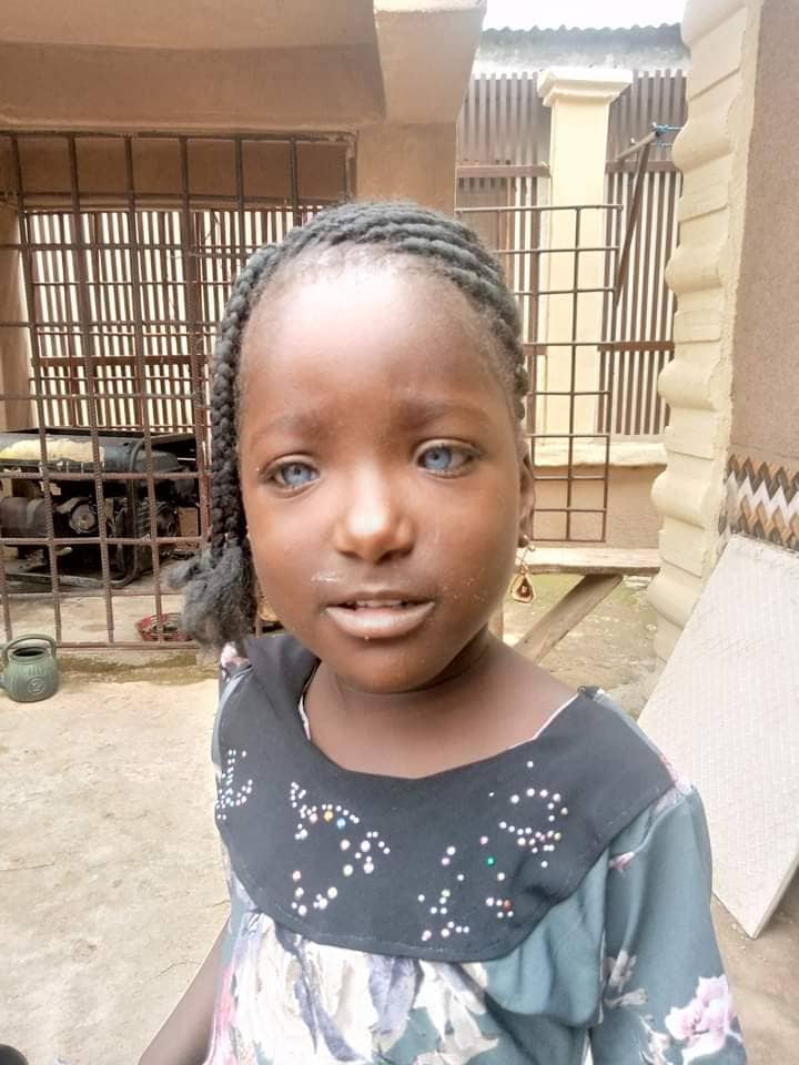 Nigerians rally round girl whose father rejected due to her blue eyes
