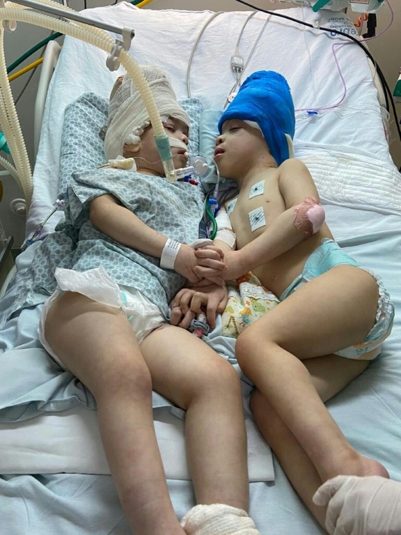 Conjoined twins Bernardo and Arthur Lima got to look each other face to face for the first time after their operation in the Instituto Estadual do Cerebro Paulo Niemeyer (IECPN) hospital in Rio de Janeiro