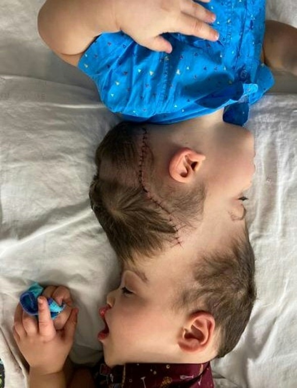 The conjoined twins were separated with help of virtual reality practise session in what experts described as the most complicated operation of its kind to date