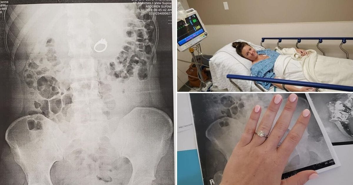 Woman accidentally swallows her engagement ring in her sleep