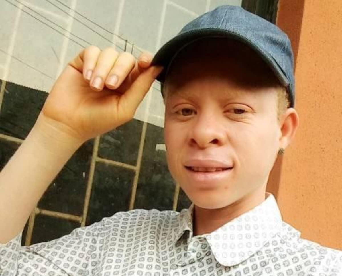 Lady with albinism realises how beautiful she is after years of stigmatisation