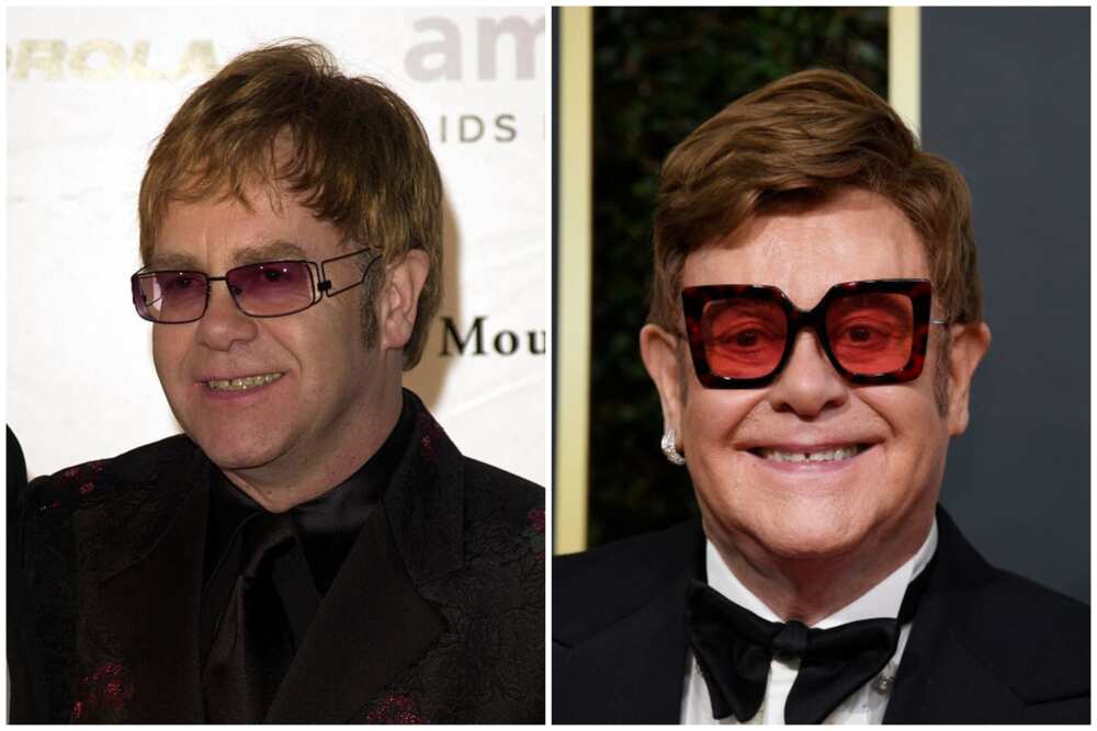 Hair transplant celebrities before and after