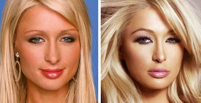 hooded eyes celebrity blepharoplasty before and after